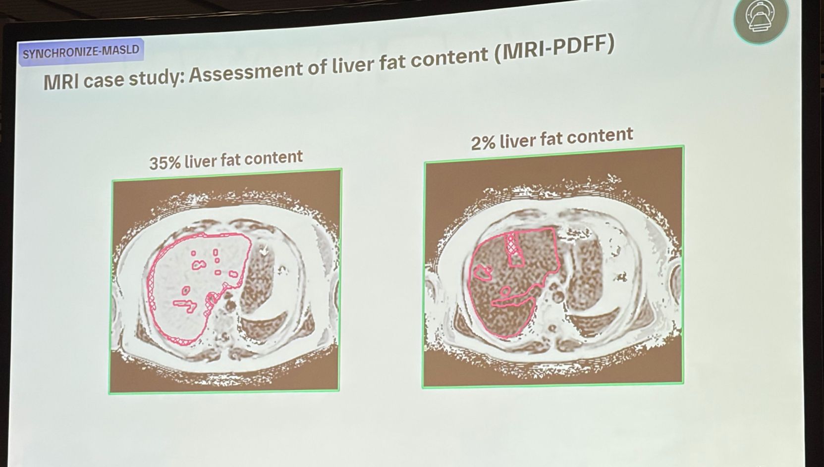 MRI-PDFF case study showing liver fat content reduced from 35% to 2% after survodutide treatment